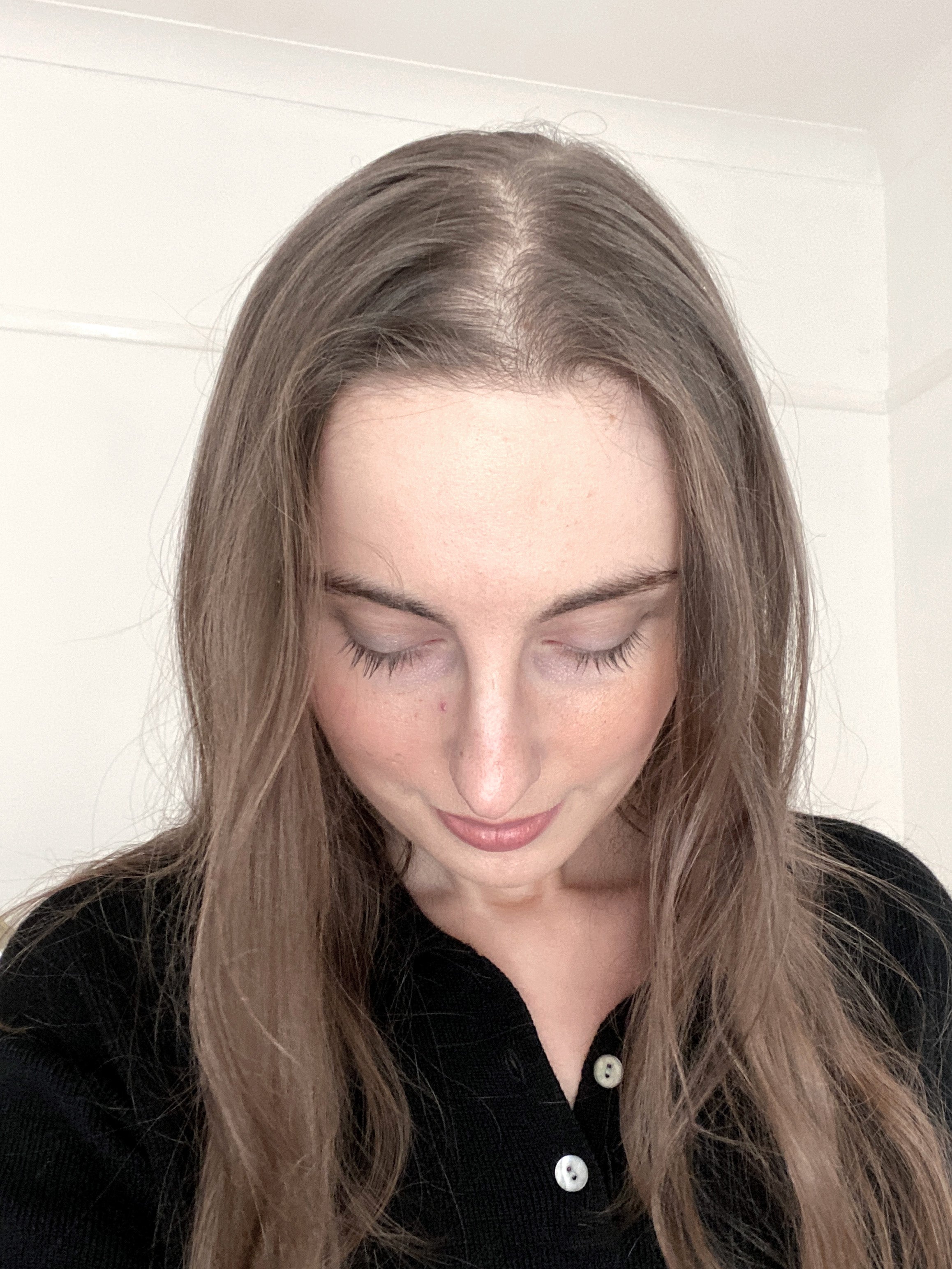 Living With Female Pattern Hair Loss & Androgenic Alopecia
